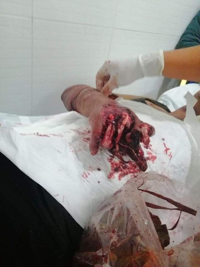 Le explota un cohete en la mano a un sujeto en San Juan Cancuc