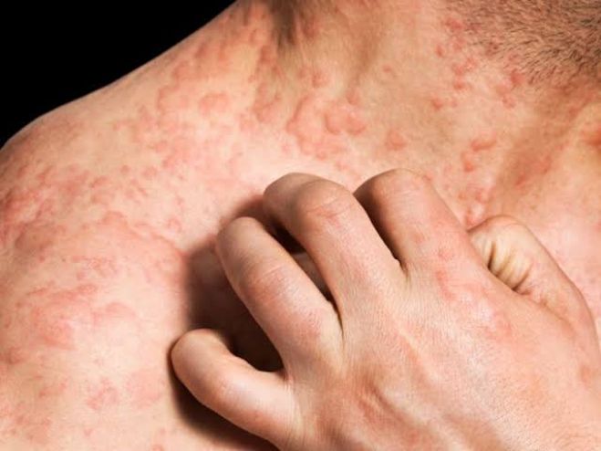 Eczcema o Eccema: Causas, Tipos y Tratamientos.