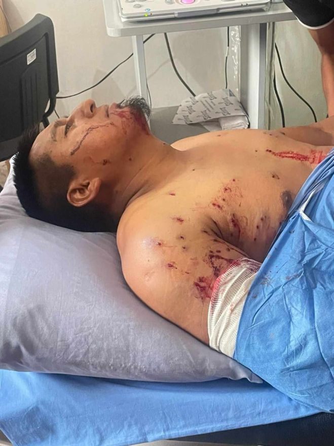 Se le accion&oacute; su arma y perdi&oacute; el brazo 